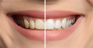 Tooth Whitening Before and After