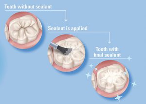 Dental Sealants and Fluoride Varnish