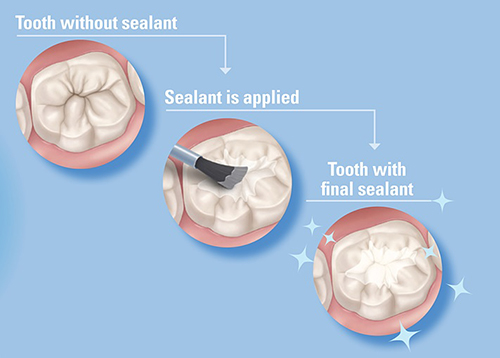 Dental Sealants and Fluoride Varnish