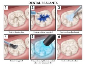 Dental Sealants