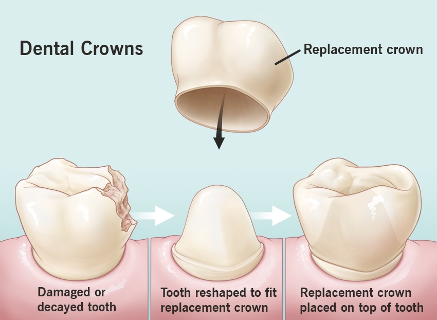 Dental Crowns