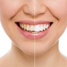 Free tooth whitening for new Invisalign Patients