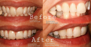 Invisalign, Composite Bonding, and Tooth Restorations: A Comprehensive Guide