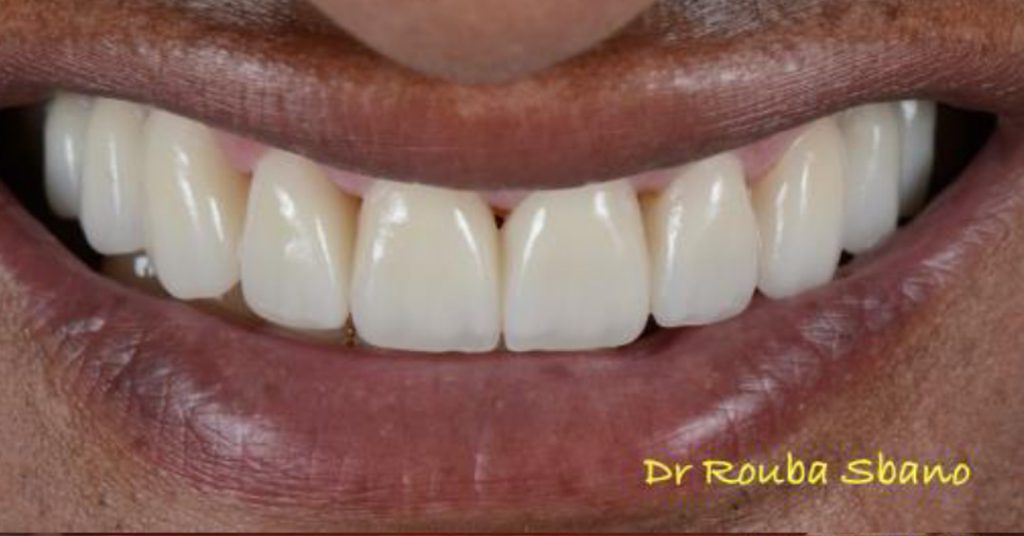 After Dental Implant