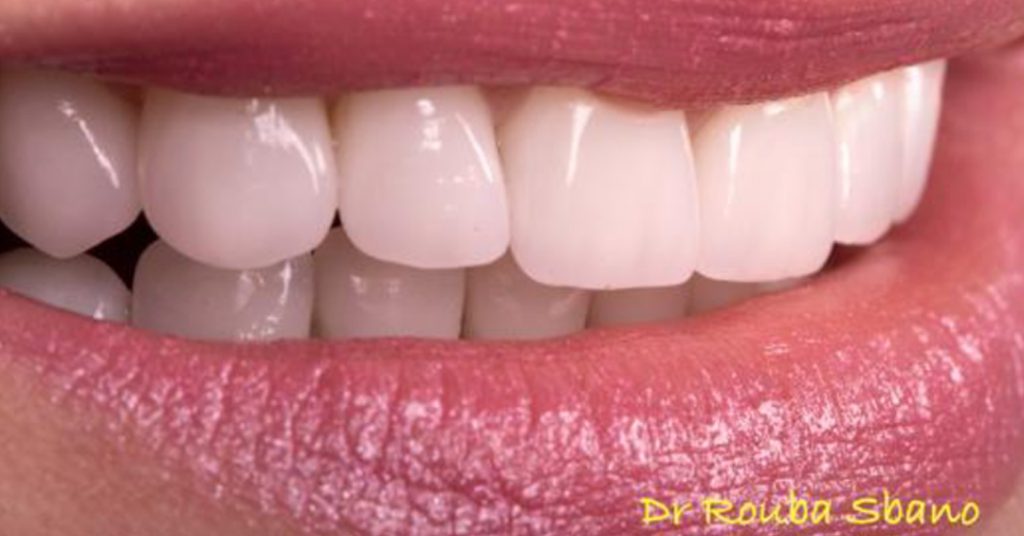 After Veneers